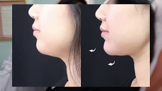 Voluma Non-Surgical Chin Augmentation | Dr. Usha Rajagopal