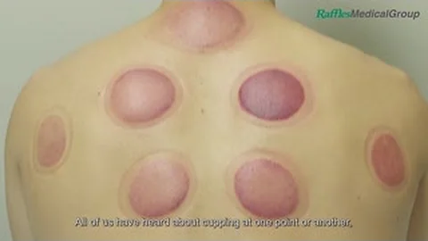 What You Need to Know about Cupping - DayDayNews