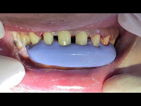Video Hướng dẫn LẤY DẤU CẮN trong phục hình cố định (phần... - youtube