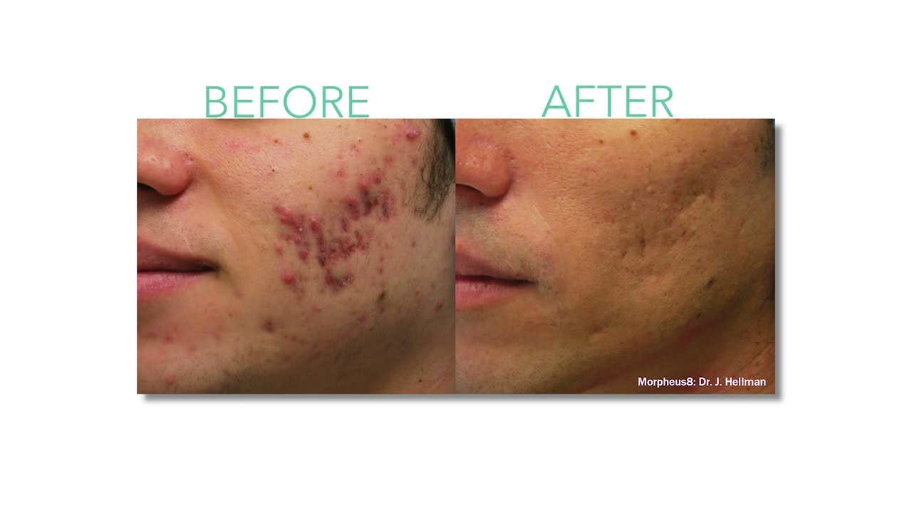 MORPHEUS8 AT O.H. WOMEN'S HEALTH & WELLNESS