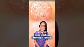 Fungal infection | kaise prevent kare | dermatologist