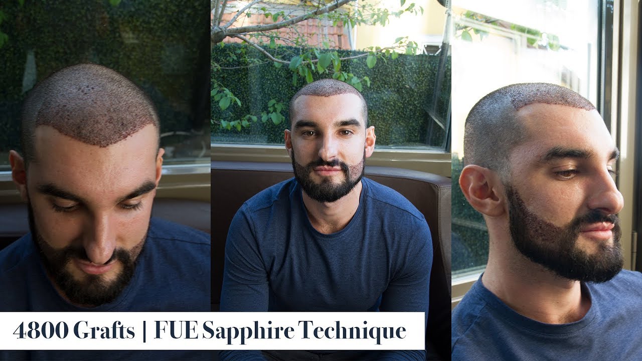 Hair Transplant Review with Our Patient from Australia Estenbul