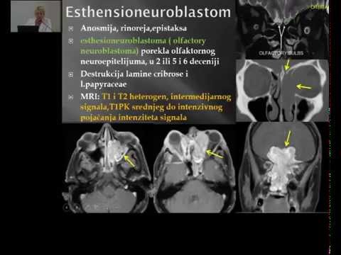 Tumori baze lobanje, Sladjana Petrovic 1_08