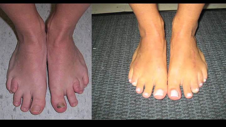 Limb Lengthening and Toe Lengthening with Dr. Rozb...