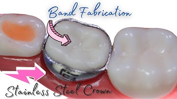 🟢Band Fabrication from Stainless Steel Crown🟡Band and Loop Space Maintainer🔵Stainless Steel Crown