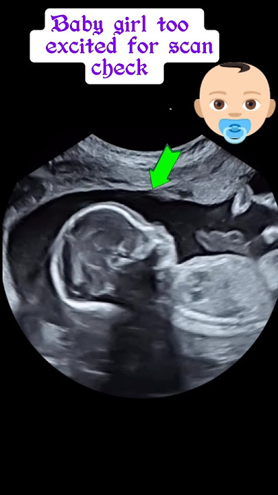 Bayi perempuan 🐥 terlalu bersemangat untuk pemeriksaan USG | USG #celana pendek #bayi #kehamilan