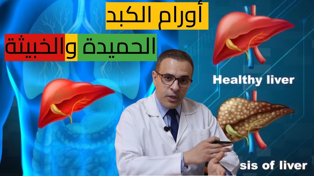 أورام الكبد الحميدة والخبيثة