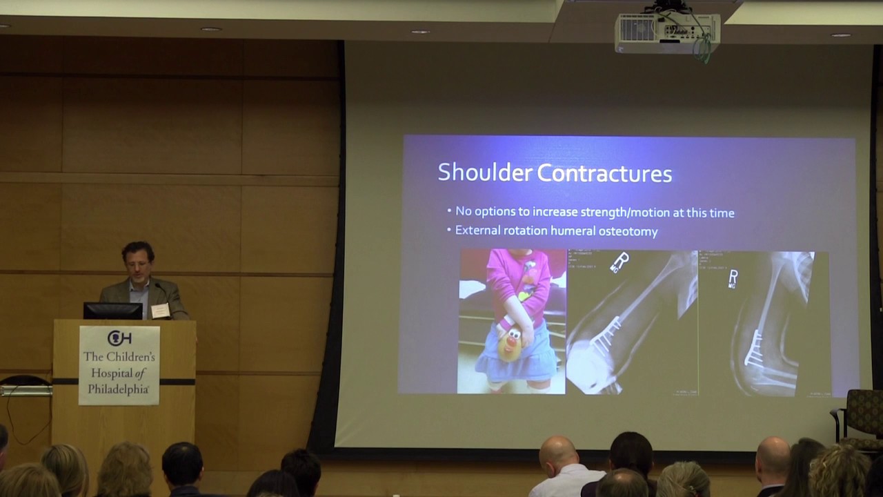 Introduction to Arthrogryposis