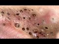 Loan Nguyen Acne Treatment 15n