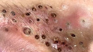 Loan Nguyen Acne Treatment 15n
