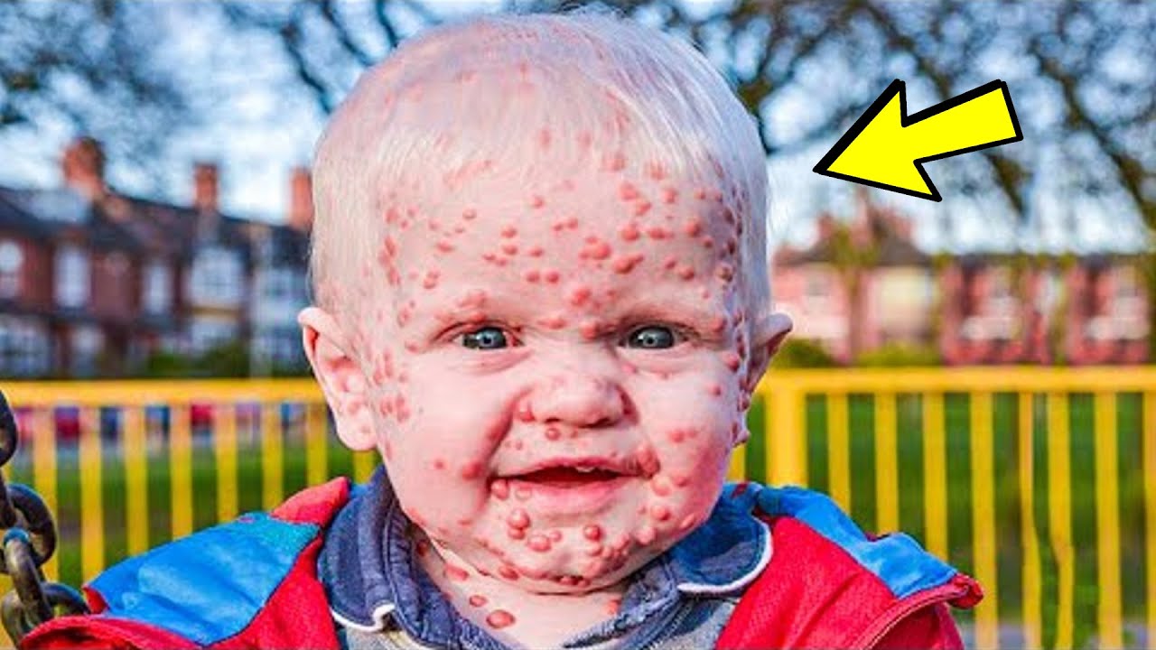 Мама думала, что у её сына ветрянка, но узнав правду, она закричала от ...