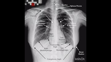 chest x ray....normal, pneumonia, tuberculosis....#xray #xrayclasses #anatomy