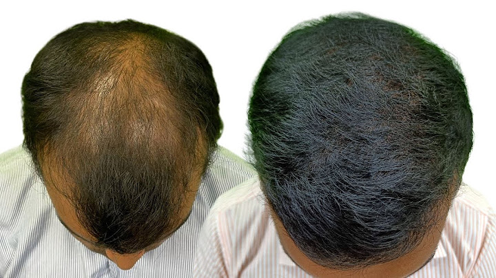 4000 Grafts Hair Transplant | Patient Experience After 4 Months | Hair Transplant Kolkata |