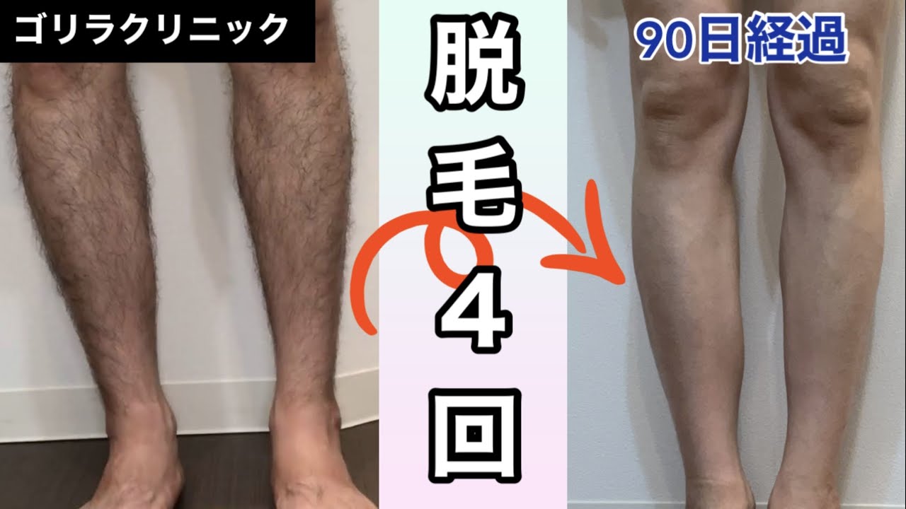 【コース終了直前のリアル】すね毛モジャモジャ男が医療脱毛4回した結果がやばい。。【ゴリラクリニック】