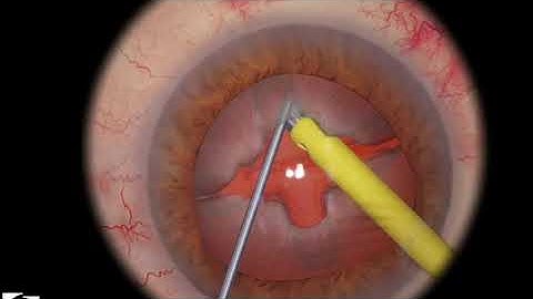 EyeSi CAT C Phaco Divide and Conquer, Level 4