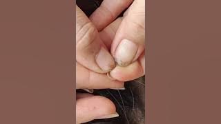 lots of lices nits#viral#share#pls