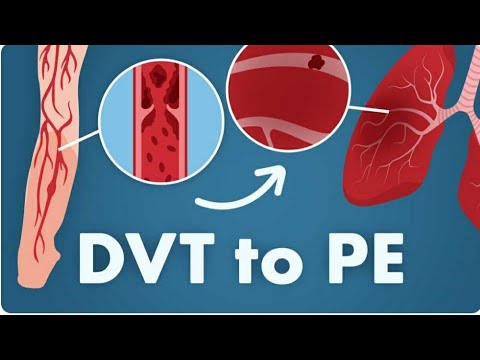 למה מפספסים תסחיף ריאתי  |  Pulmonary Embolism