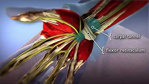 Carpal Tunnel Syndrome