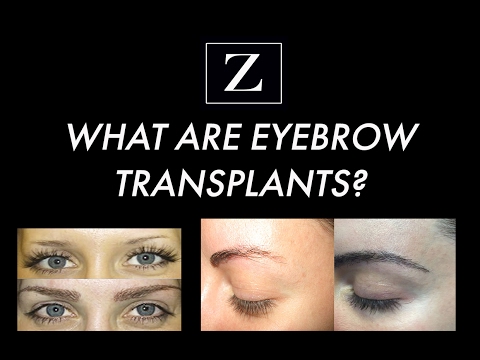 Eyebrow Transplant Surgery...What Are Eyebrow Transplants?