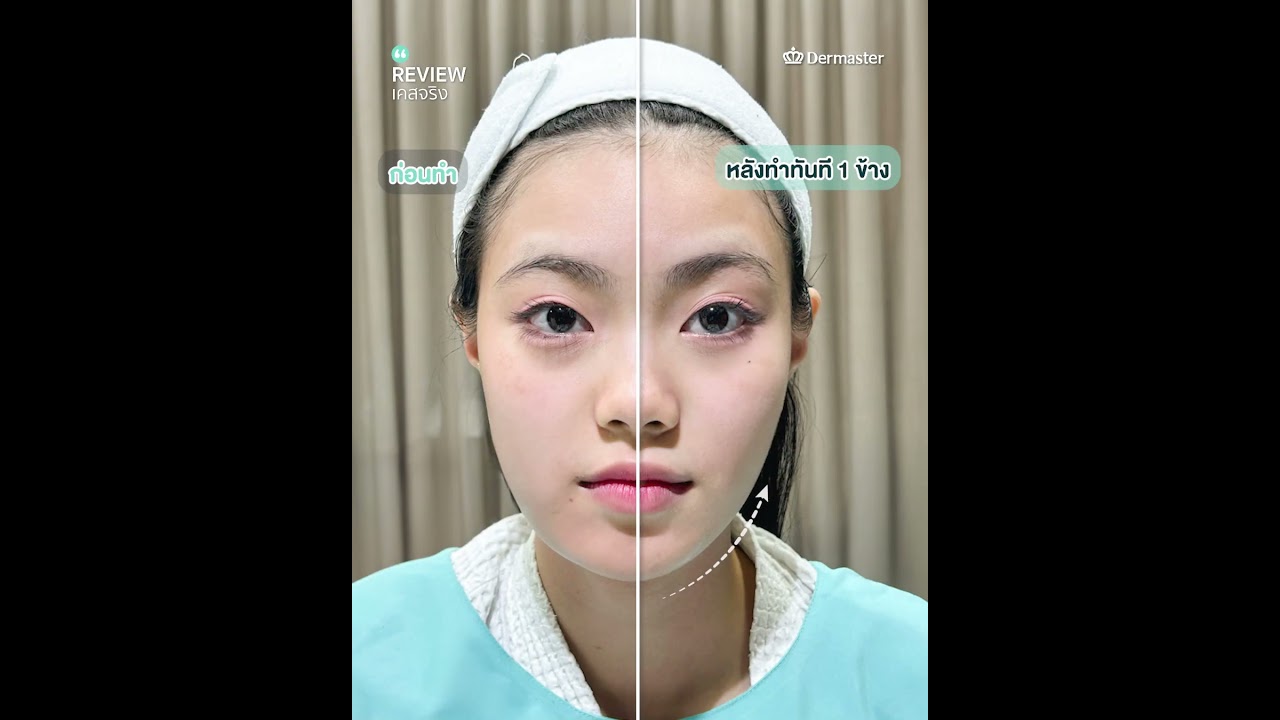 ยก ตึง ดึง เรียว 𝑷𝒓𝒐𝒈𝒓𝒂𝒎 𝑻𝒉𝒆𝒓𝒎𝒂𝒈𝒆 𝑭𝑳𝑿 💜 เทคนิค 𝑺𝒖𝒓𝒈𝒆𝒐𝒏 𝑳𝒊𝒏𝒆 เฉพาะที่ Dermaster