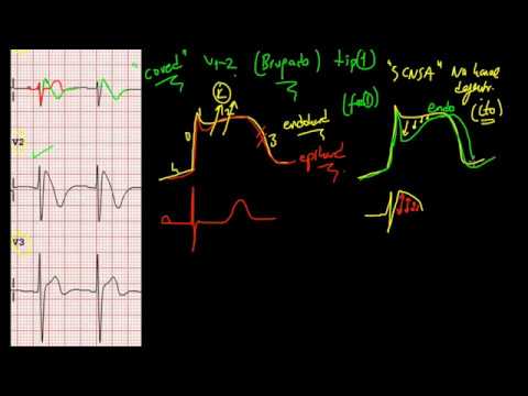 Brugada Sendromu(EKG)