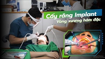 Răng bị nứt không giữ lại được và phương pháp cấy chân răng phục hồi răng mất