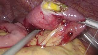 『微創手術』腹腔鏡膽結石性腸阻塞手術 laparoscopic operation for gallstone ileus
