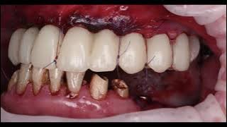 Dental Surgery Small Cyst Removal by Oral Surgeon Dr Clove #Dendal #trending #dendal #dentist