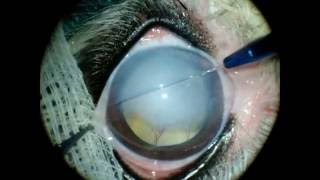 Gundersen Flap in severe corneal edema screenshot 2