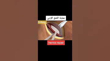 عمليه الفتق الاربي 