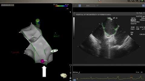 Hands-On Ablation - Video 44.20