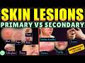 Primary and Secondary Skin Lesions: Morphologic Terminology | Skin Infections