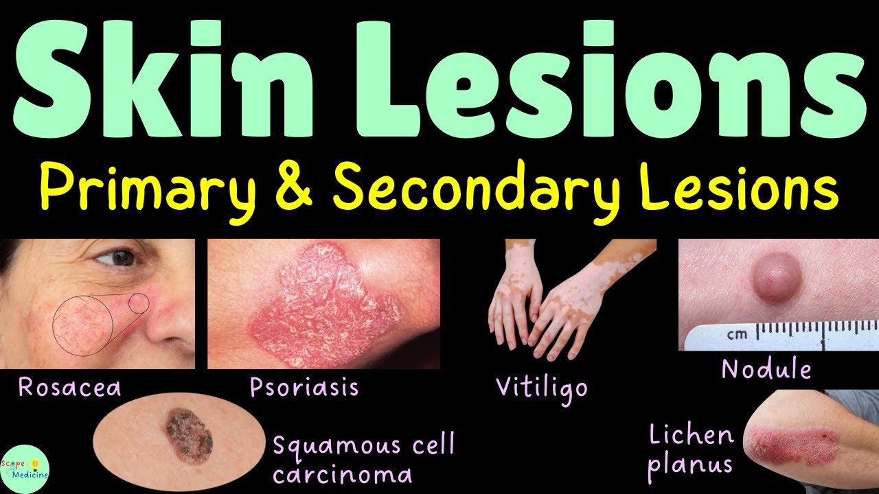 Primary and Secondary Skin Lesions: Morphologic Terminology | Skin Infections