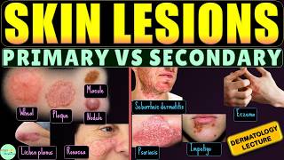 Primary and Secondary Skin Lesions: Morphologic Terminology | Skin Infections