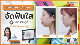 รีวิวการแก้ฟันยื่น ปากยื่น ปากอูม ( before after ) ในวัยรุ่น โดยใช้การจัดฟันใส invisalign ของหมอนา