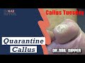 Quarantine Week 2 - Calluses and Corns [Callus Tuesday] (2020)