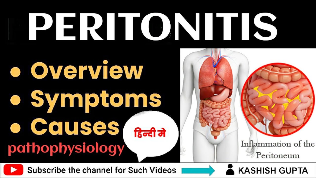 Peritonitis in hindi - पेट की झिल्ली का रोग || Nursing education - YouTube