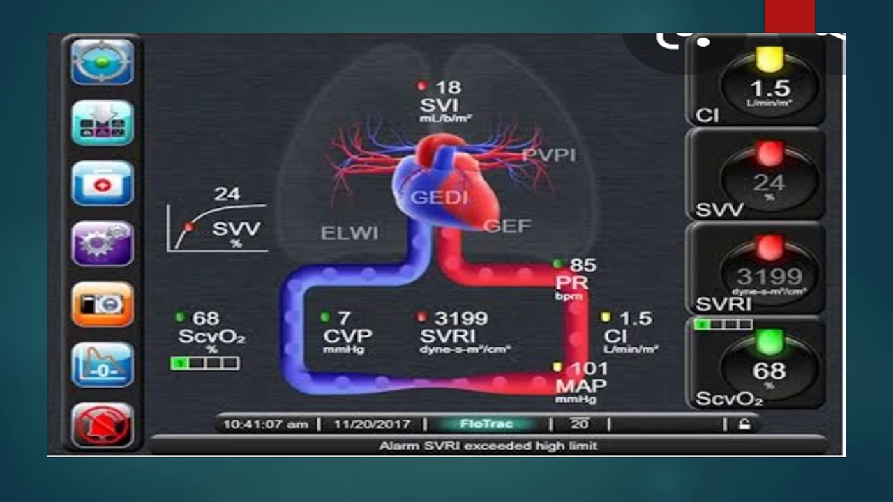 Parâmetros de Alguns Monitores de Hemodinâmica em UTI - Se inscreva e Assista a Vários Vídeos de UTI