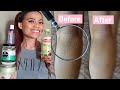 How to Remove Stretch Marks Instantly | Fast Remedies at Home