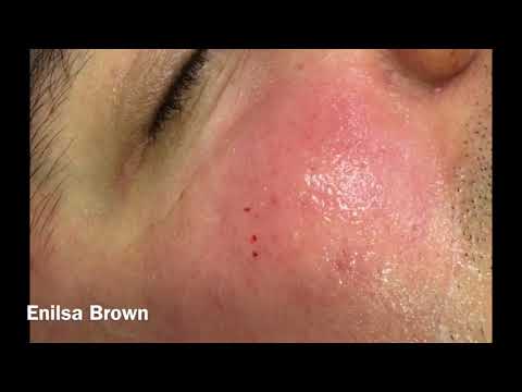 Christian&#;s Acne Treatment ( Blackheads Extractions)