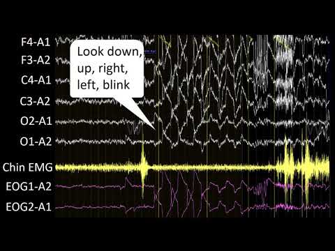 Video: Multiple Sleep Latency Test (MSLT): Oversigt Og Hvornår Der Skal Testes