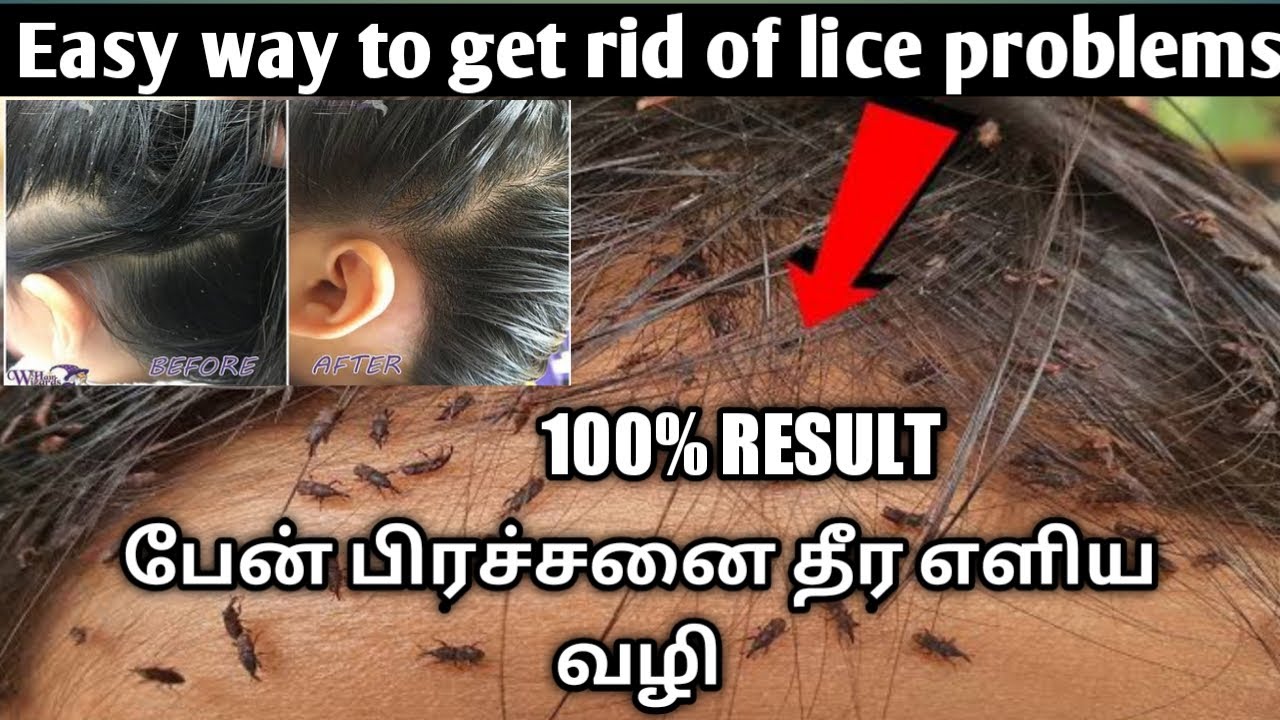 பேன் பிரச்சனை எளிதில் தீர ll EASY WAY TO GET RID OF LICE PROBLEMS IN