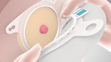 How to apply SenSura Mio with click application – instructional video, point of view of nurse