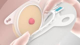 How to apply SenSura Mio with click application – instructional video, point of view of nurse screenshot 4