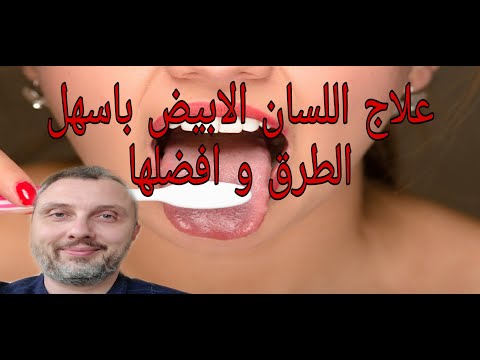 علاج اللسان الابيض و الفطريات كانديدا و القلاع بأسهل الطرق الصحية