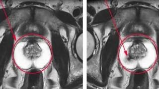 Bookimed. Современная диагностика рака простаты
