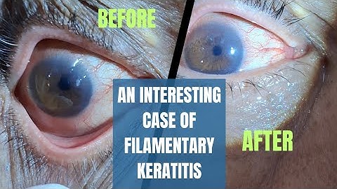 An interesting case of Filamentary keratitis | video recognition series | ophthalmology case - 14