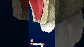 Sinus Lift Surgery : 3D Animation