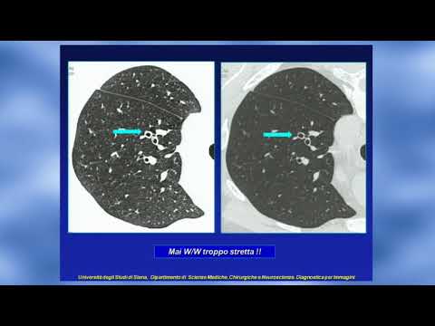 Video: TC Toracica Per Sospette Complicanze Polmonari Delle Terapie Oncologiche: Come Rivedo E Riferisco