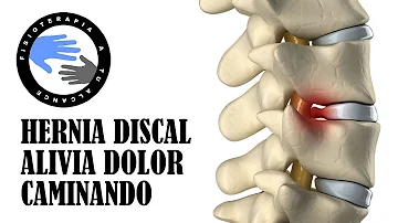 ¿Es bueno caminar para una hernia?